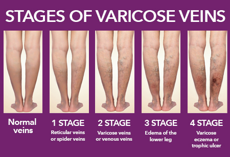 Varicose Vein Removal