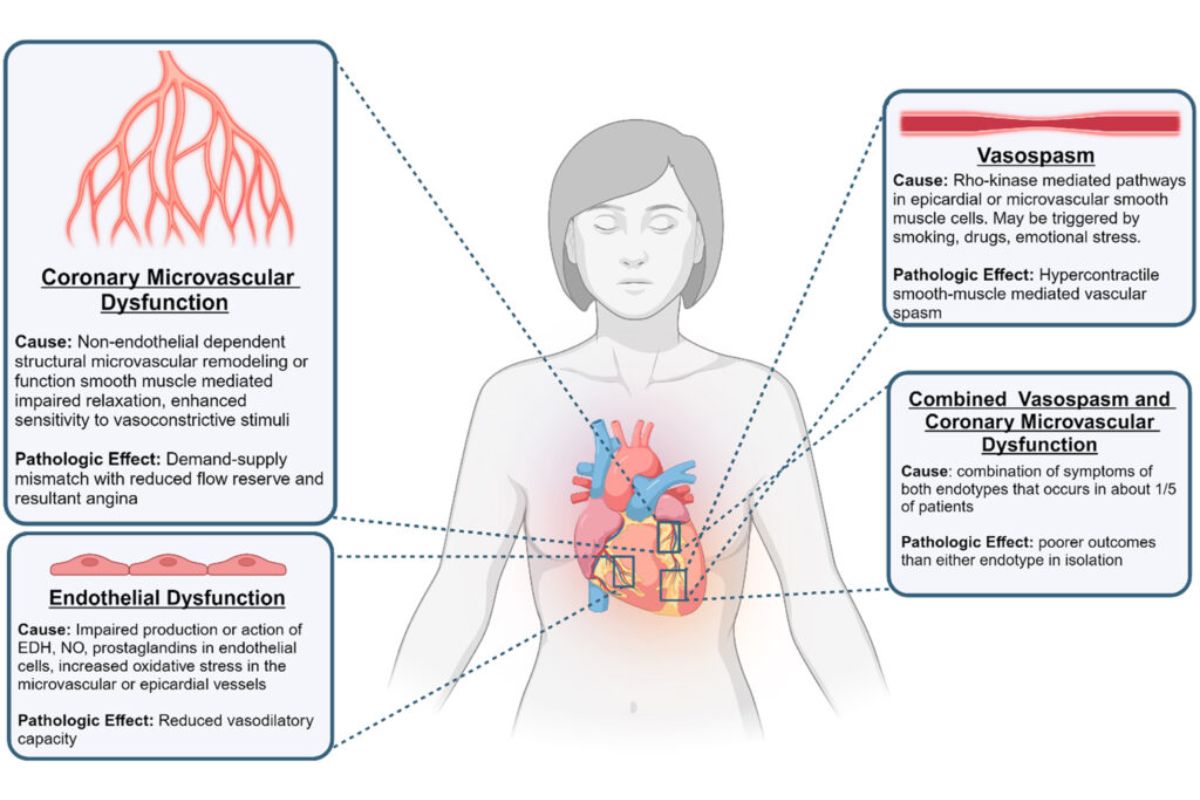 HonorHealth Heart Care - Figure of ANOCA, a heterogeneous condition with multiple mechanistic pathways.