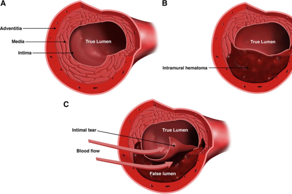 HonorHealth Heart Care - Figure of spontaneous coronary artery dissection (SCAD) anatomy and presentation.
