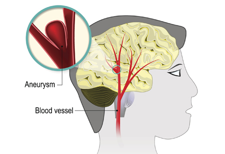 Aneurysm treatment improves over last 30 years