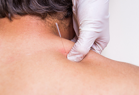 6 Things to Know About Dry Needling