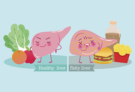 Learn about fatty liver disease from experts at HonorHealth