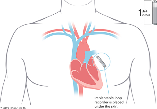 Watchman Device Explained And Faq S Answered By A Cardiologist Myheart
