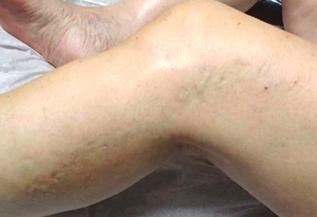 Treatment zaps varicose veins with laser