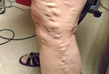 Treatment zaps varicose veins with laser