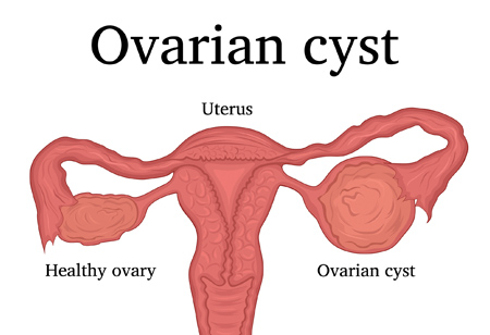 Ovarian Cysts Often Resolve On Their Own Honorhealth
