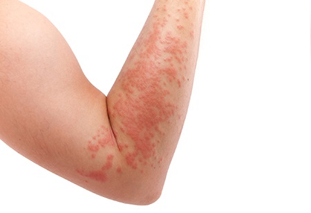 Can xanax cause itchy acne on arms and legs