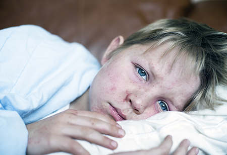 Herd immunity drops, allowing measles to sneak back