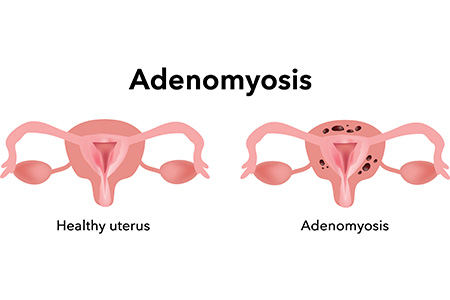 Image result for adenomyosis