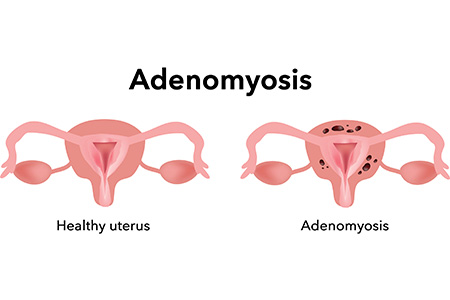 Adenomyosis