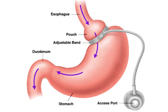 HonorHealth - Adjustable Gastric Band