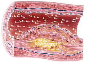 HonorHealth - Coronary Artery Disease
