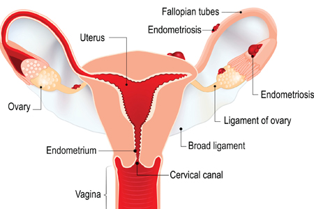 Endometriosis