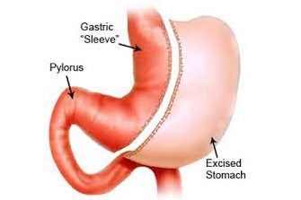 HonorHealth - Gastric Sleeve