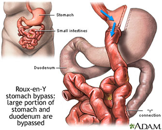 HonorHealth Bariatric Weight Loss - Gastric Bypass Surgery Roux-en-Y