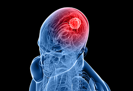 Brain tumor care from HonorHealth