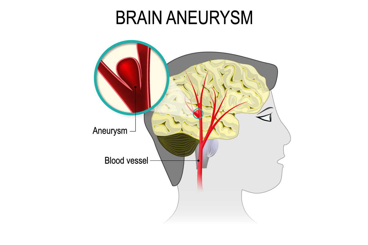 Brain aneurysm