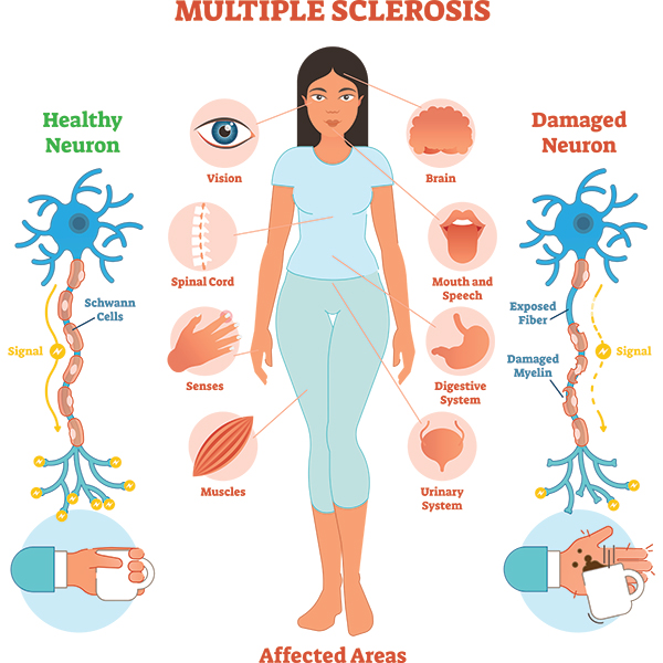 Image result for multiple sclerosis pictures
