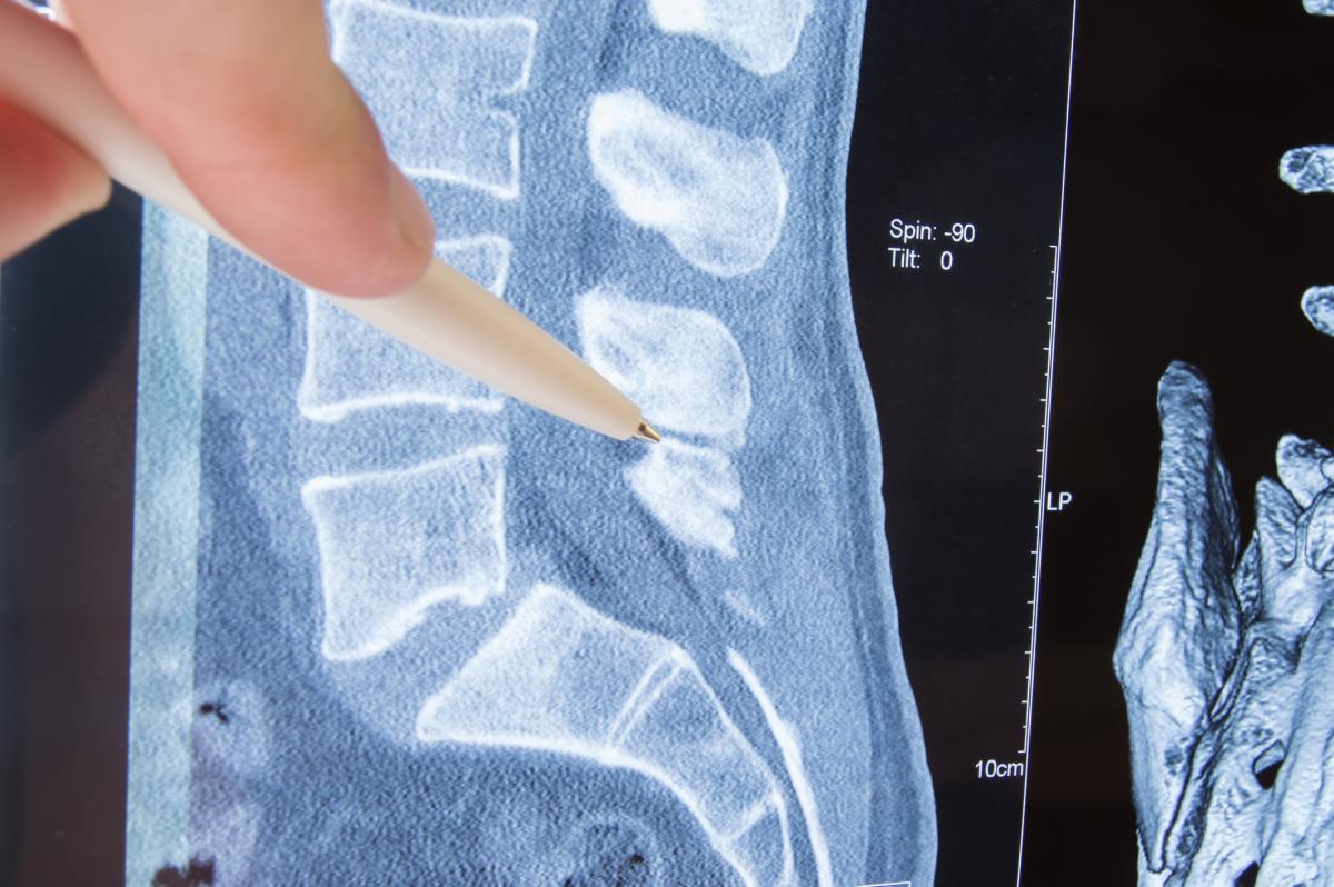 Spinal stenosis