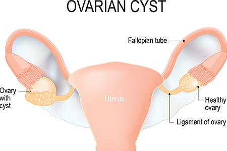 Cyst meaning