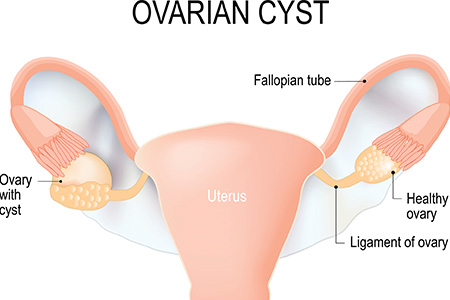 Ovarian cysts