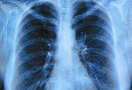Smokers Lungs Vs Healthy Lungs Know The Difference Smokers Lungs Vs Healthy Lungs Know The Difference