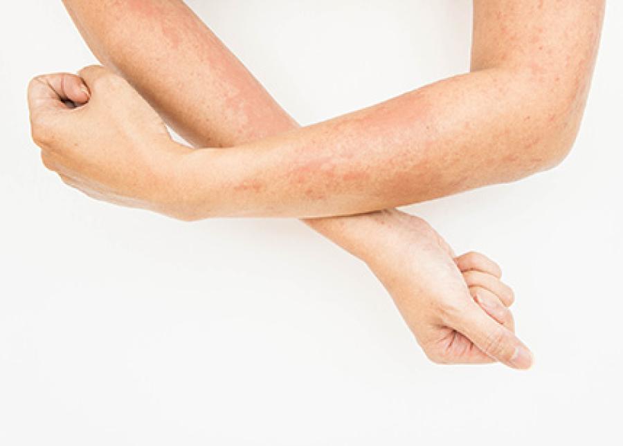 Skin Rash After Virus May Look Alarming But It S Not Uncommon Honorhealth
