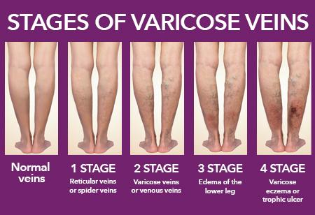 Learn more about varicose veins from vascular experts at HonorHealth