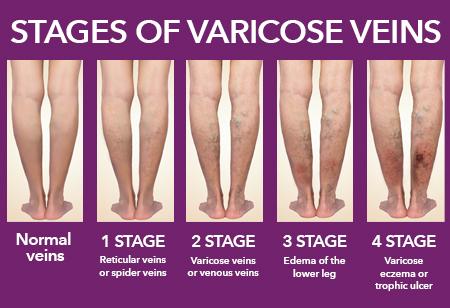 Learn more about varicose veins from vascular experts at HonorHealth