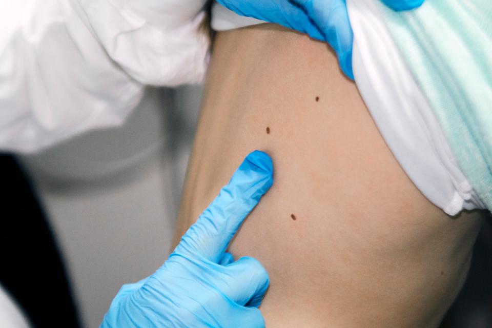 Keep your skin in check - Skin cancer screening with Dermatology experts at HonorHealth