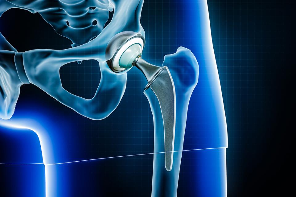 Hip replacement diagram - HonorHealth Orthopedics