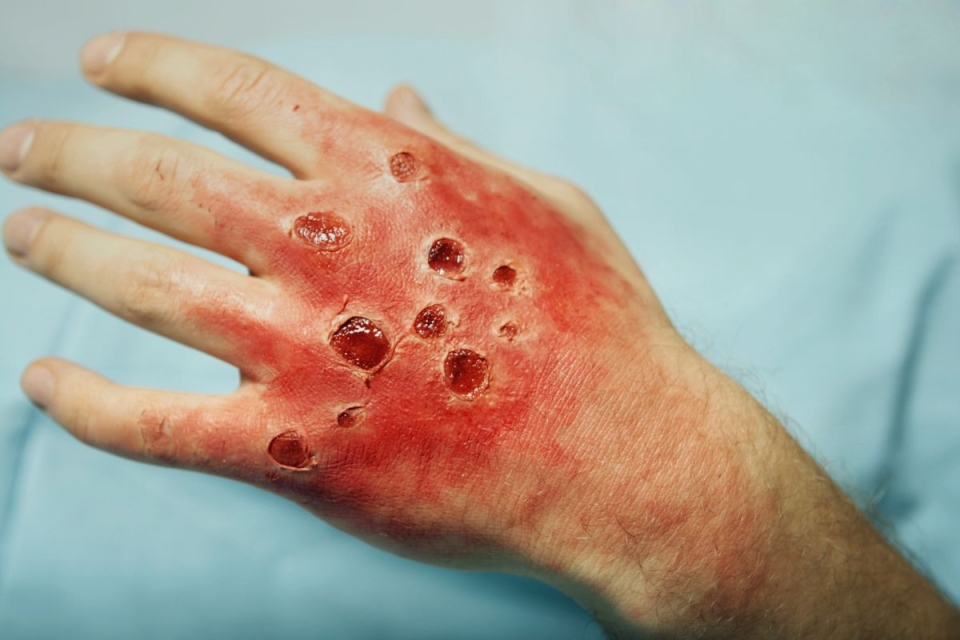 HonorHealth Emergency Services - Image shows burned hand injured while trying to light fireworks on the Fourth of July.