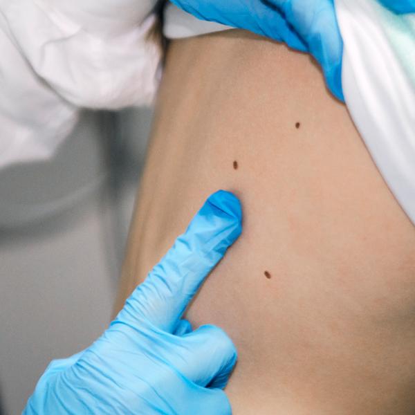 Keep your skin in check - Skin cancer screening with Dermatology experts at HonorHealth