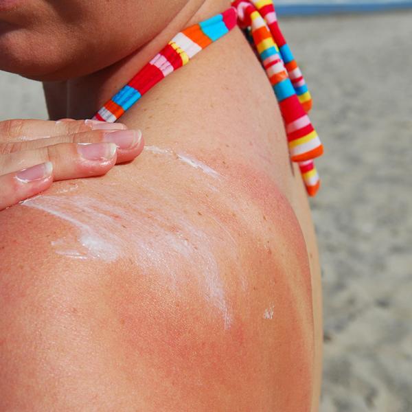 Feeling the burn? What you need to know about sunburns