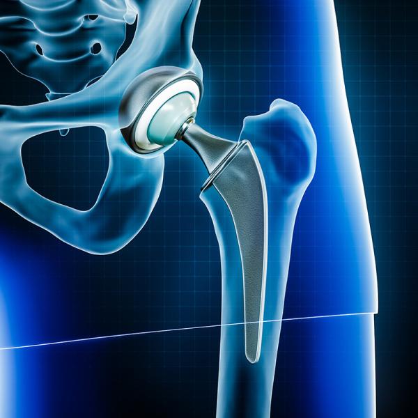 Hip replacement diagram - HonorHealth Orthopedics