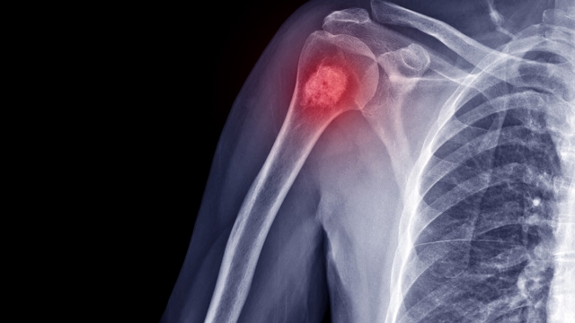 Orthopedic oncology - HonorHealth