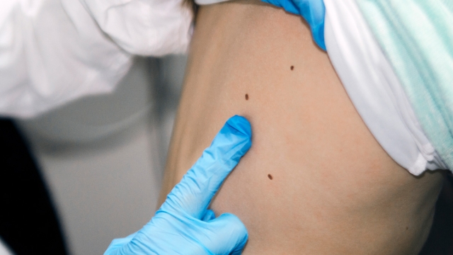 Keep your skin in check - Skin cancer screening with Dermatology experts at HonorHealth