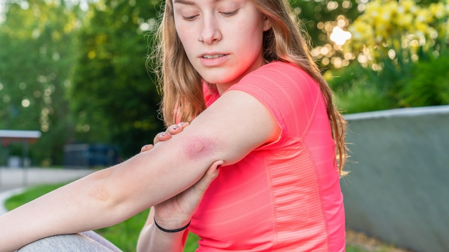 What to do for bits and stings. Quality information from medical experts at HonorHealth.