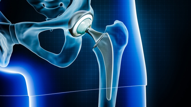 Hip replacement diagram - HonorHealth Orthopedics
