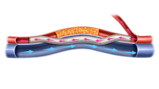 HonorHealth first in Arizona approved to perform percutaneous transmural arterial bypass (PTAB) therapy.