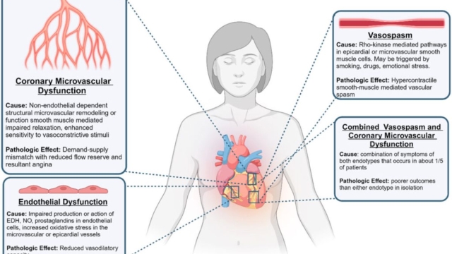 HonorHealth Heart Care - Figure of ANOCA, a heterogeneous condition with multiple mechanistic pathways.