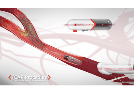 TCAR: a minimally invasive alternative to prevent stroke